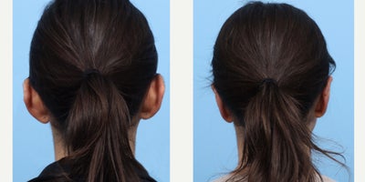 Case 11083 - 25-34 year old woman treated with Ear Surgery