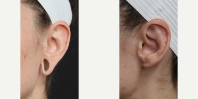 Case 11084 - Woman treated with Ear Surgery