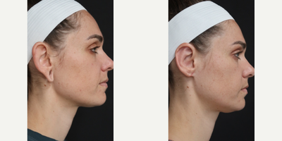 Case 11086 - Woman treated with Ear Surgery