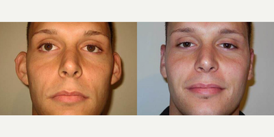 Case 11089 - Man treated with Ear Surgery