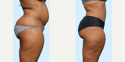 Case 1109 - Woman treated with Tummy Tuck