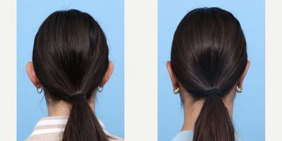 Case 11090 - 18-24 year old woman treated with Ear Surgery