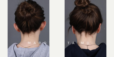 Case 11094 - Woman treated with Ear Surgery