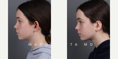 Case 11095 - Woman treated with Ear Surgery