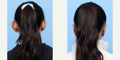 Case 11097 - 25-34 year old woman treated with Ear Surgery