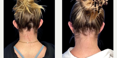 Case 11099 - Woman treated with Ear Surgery