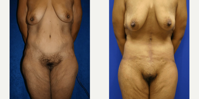 Case 111 - Woman treated with Tummy Tuck