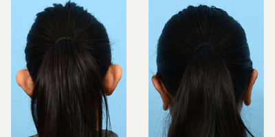 Case 11101 - 25-34 year old woman treated with Ear Surgery