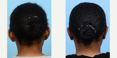 Case 11102 - 25-34 year old woman treated with Ear Surgery