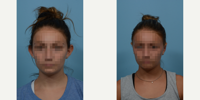 Case 11103 - 17 or under year old woman treated with Ear Surgery