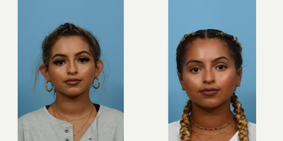 Case 11104 - 18-24 year old woman treated with Ear Surgery