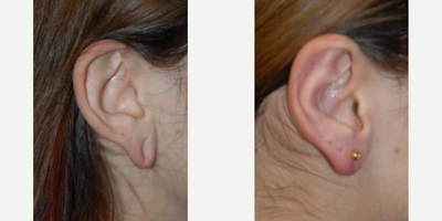 Case 11105 - Woman treated with Ear Surgery