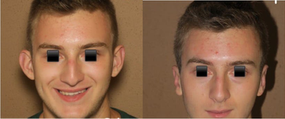 Case 11106 - Man treated with Ear Surgery