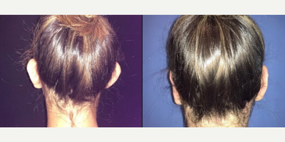 Case 11107 - Woman treated with Ear Surgery