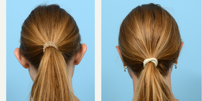 Case 11108 - 18-24 year old woman treated with Ear Surgery