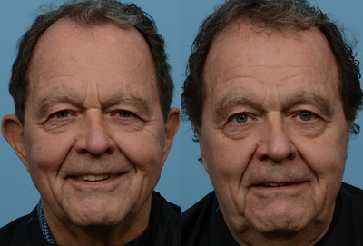 Case 11109 - Man treated with Ear Surgery