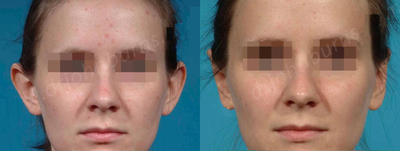 Case 11111 - Woman treated with Ear Surgery