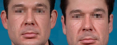 Case 11112 - Man treated with Ear Surgery