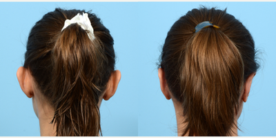 Case 11113 - 25-34 year old woman treated with Ear Surgery