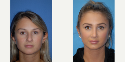 Case 11116 - 25-34 year old woman treated with Ear Surgery