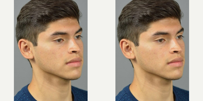 Case 11118 - Woman treated with Ear Surgery