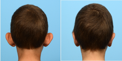 Case 11119 - 17 or under year old man treated with Ear Surgery