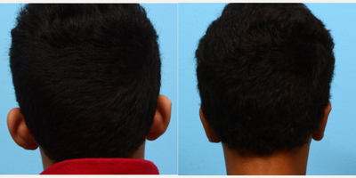 Case 11120 - 17 or under year old man treated with Ear Surgery