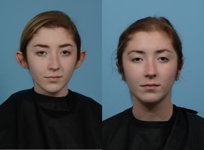 Case 11121 - Woman treated with Ear Surgery