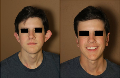 Case 11123 - 17 or under year old man treated with Ear Surgery