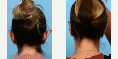 Case 11125 - 35-44 year old woman treated with Ear Surgery