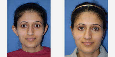 Case 11127 - 25-34 year old woman treated with Ear Surgery