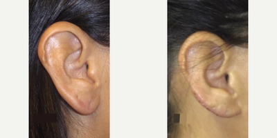 Case 11128 - Woman treated with Ear Surgery