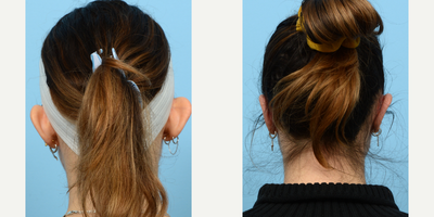 Case 11129 - 25-34 year old woman treated with Ear Surgery