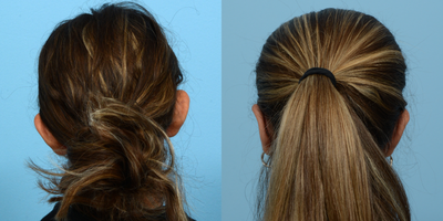 Case 11130 - 17 or under year old woman treated with Ear Surgery