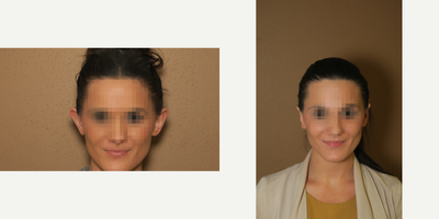 Case 11132 - 25-34 year old woman treated with Ear Surgery