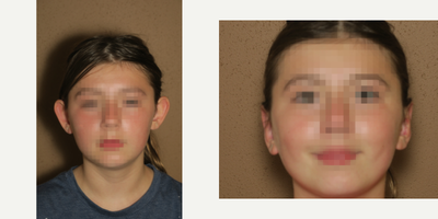 Case 11138 - 17 or under year old woman treated with Ear Surgery