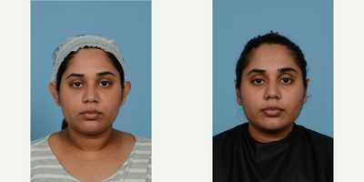 Case 11139 - Woman treated with Ear Surgery