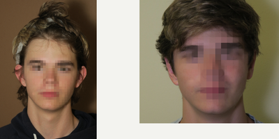 Case 11142 - 18-24 year old man treated with Ear Surgery