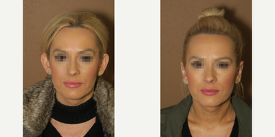 Case 11143 - 25-34 year old woman treated with Ear Surgery