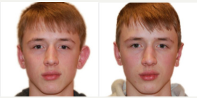 Case 11144 - Young man treated with Ear Surgery