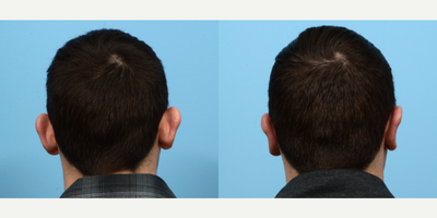 Case 11145 - 25-34 year old man treated with Ear Surgery