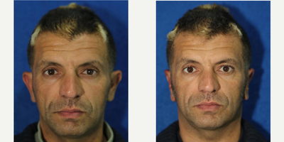 Case 11147 - Otoplasty for Protruding Ears  (front view)