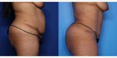 Case 1115 - 25-34 year old woman treated with Tummy Tuck