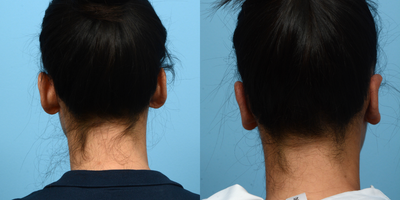 Case 11152 - 25-34 year old woman treated with Ear Surgery