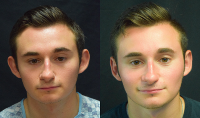 Case 11154 - 18-24 year old man treated with Ear Surgery