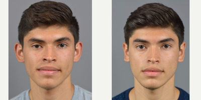 Case 11155 - 18-24 year old man treated with Ear Surgery