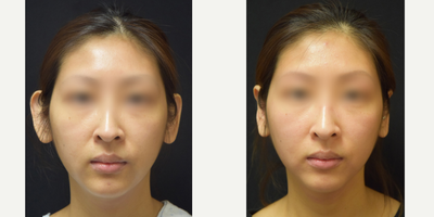 Case 11156 - 25-34 year old woman treated with Ear Surgery