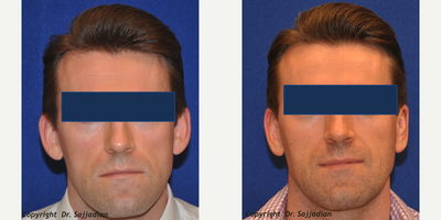 Case 11157 - Ear Surgery