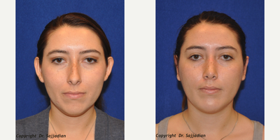 Case 11158 - Ear Surgery