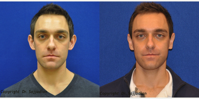 Case 11159 - Ear Surgery